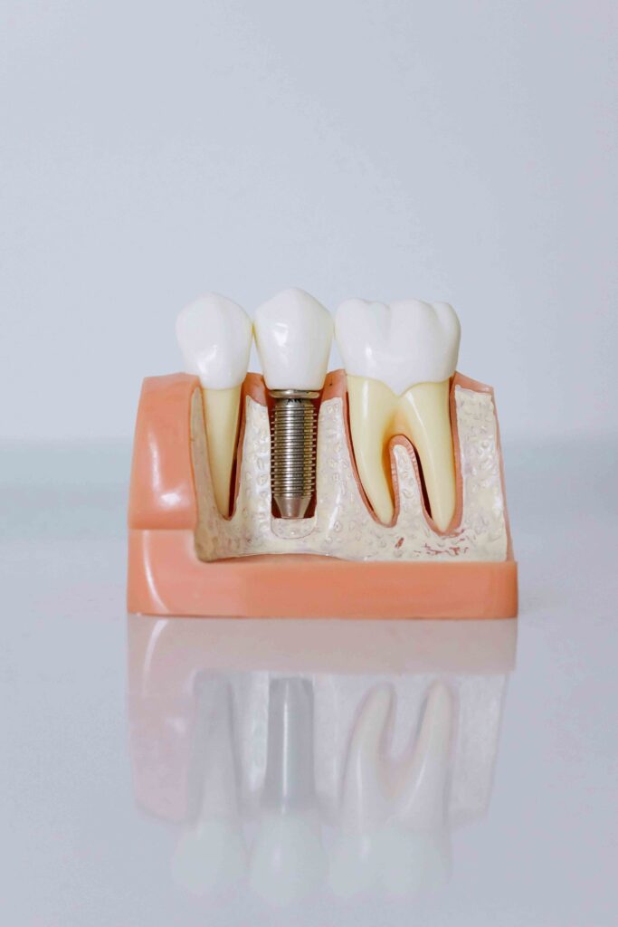 Modelo de implante dental utilizado en tratamientos dentales en Bétera